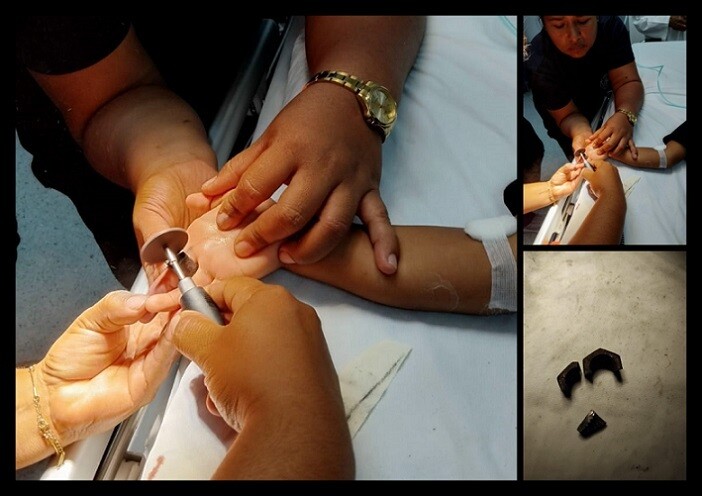 Child in Panama hospitalized after nut gets stuck on finger