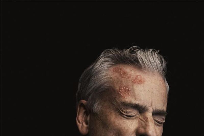 Shingles Education: Myths and Realities for Adults with Chronic Conditions