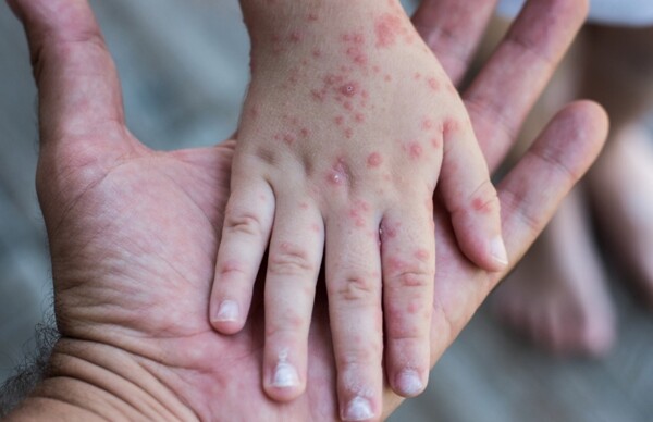 Minsa reinforces epidemiological surveillance amid measles cases in Costa Rica