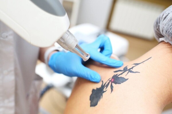 How To Remove Unwanted Ink While Protecting Your Skin And Health